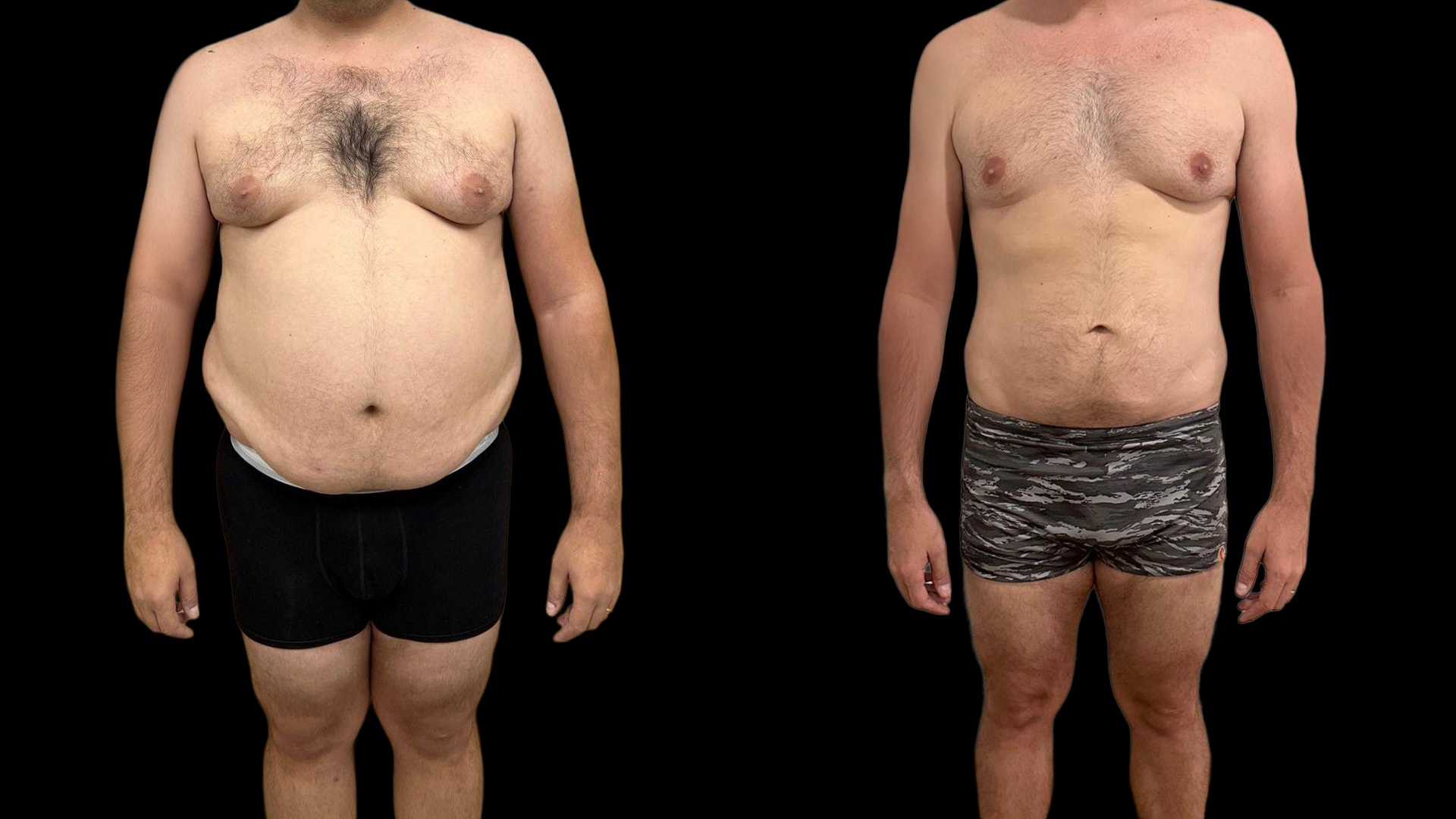 Antes e depois de José, paciente do Caian Maroni