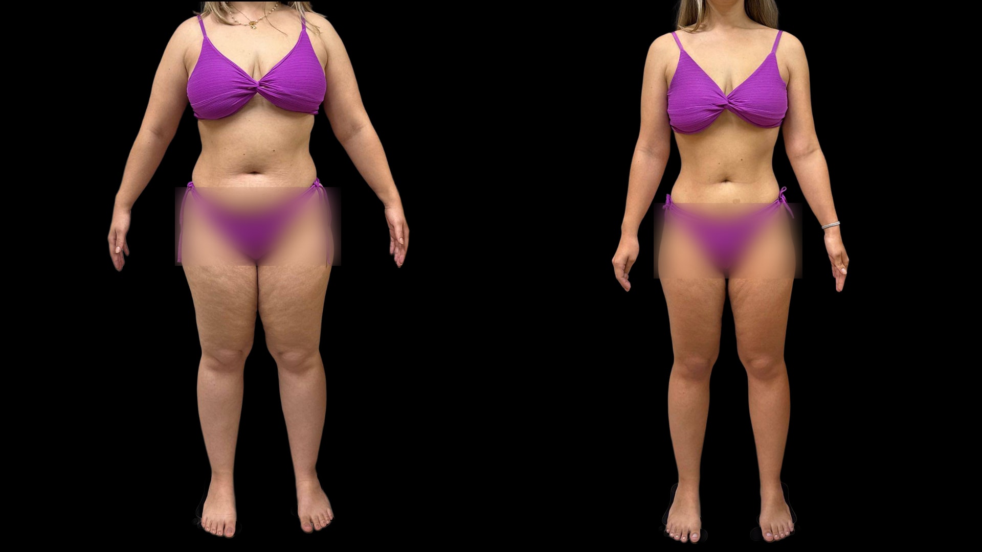 Antes e depois de Fernanda, paciente do Caian Maroni