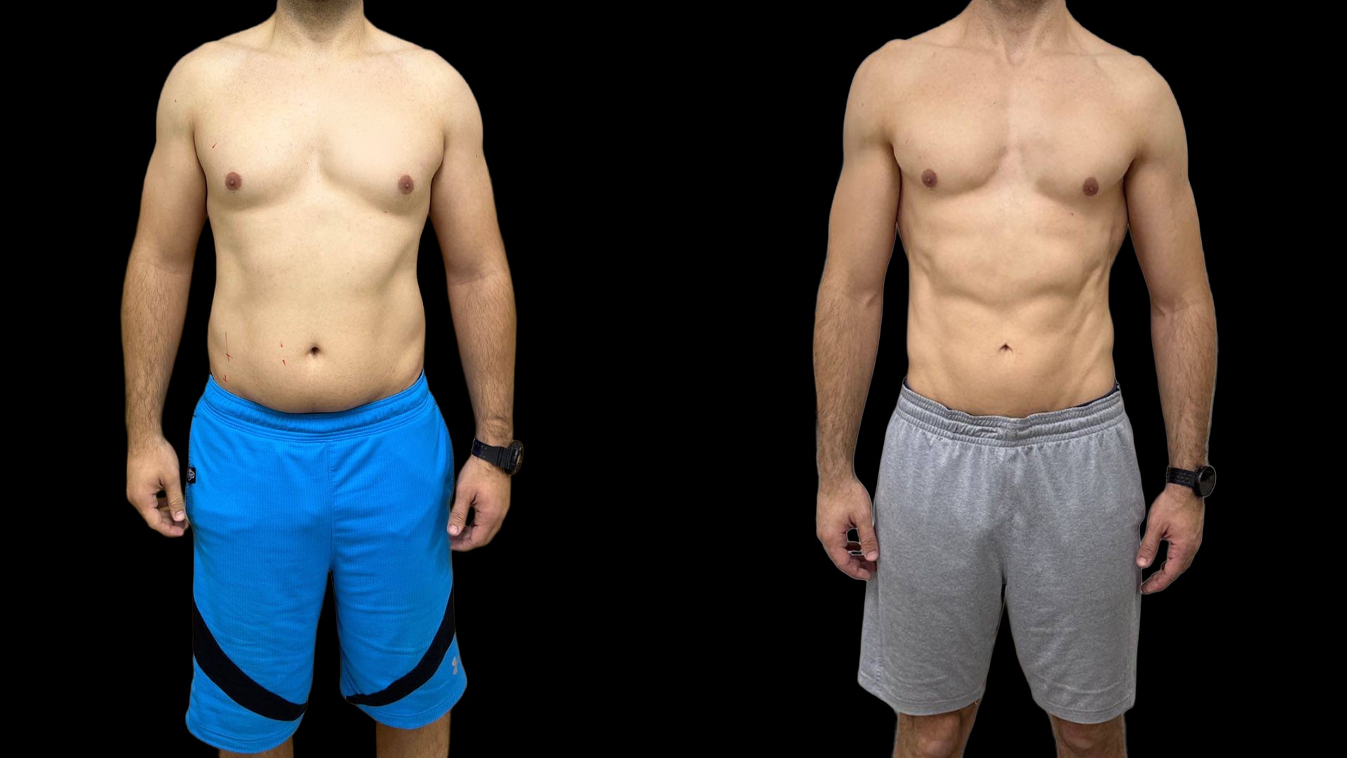 Antes e depois de Luiz, paciente do Caian Maroni